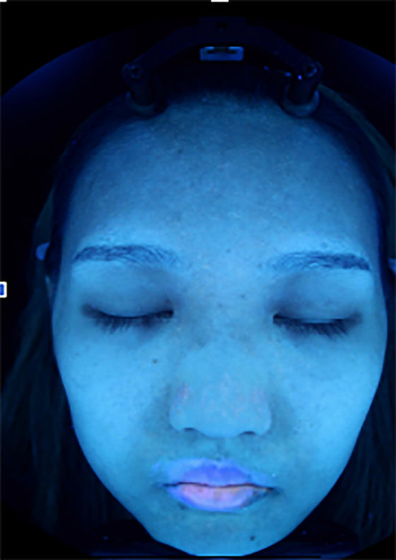 Sonaki Clinical Study